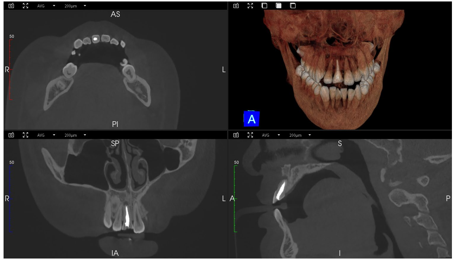 Dental Implant Orthodontic CBCT System High-Resolution 3D Imaging for Precise Diagnosis