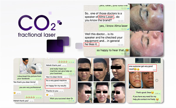 Машина 10600nm лазера СО2 клиники 60W салона частичная