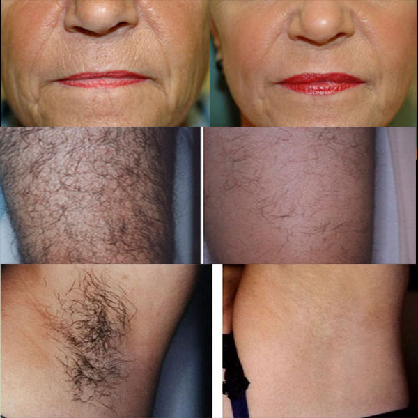 AFT SHR Hair Removal Machine , 650-950nm(HR) IPL Beauty Machine