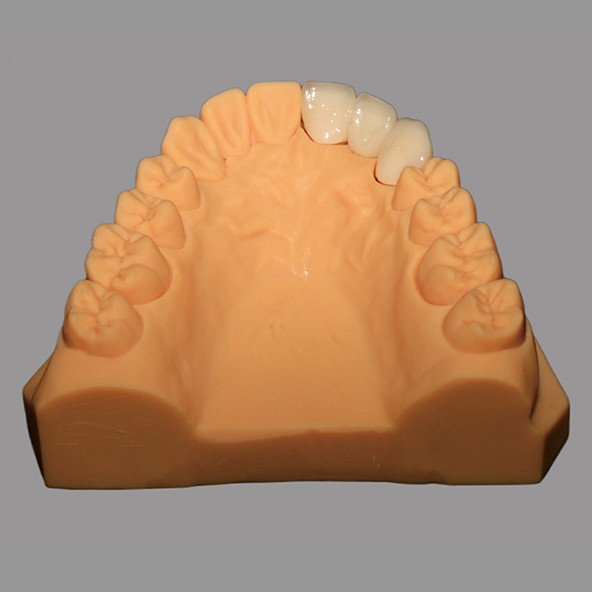 Puente PFZ de cerámica completa biocompatible con sistema CAD/CAM