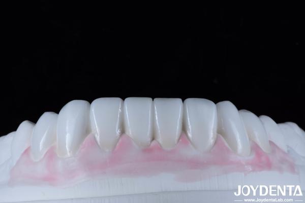 Finition dentaire composite durable Bonne biocompatibilité Pas de goutte de finition de porcelaine