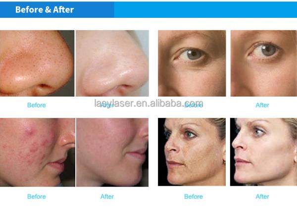 Skin Analyzer Beauty Salon Equipment Ultrasonic Hydro Facial Machine Beauty Dermabrasion Machine