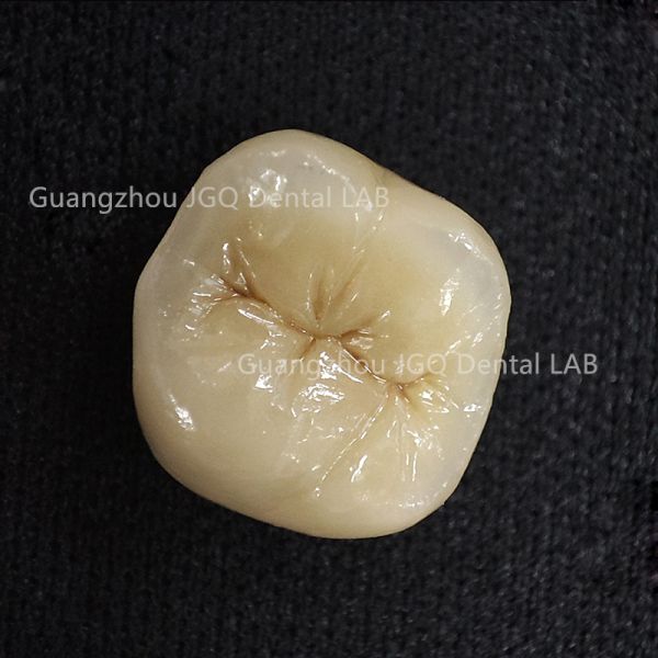 Digital 3D Printing Pfm Metal Ceramic Crowns and Bridges Aesthetically Pleasing