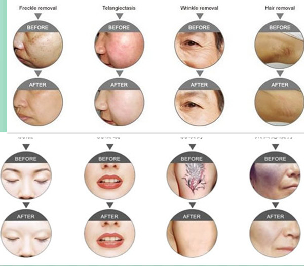 Multifunction E- Light Hair Removal Machine Laser RF Skin Care Machine