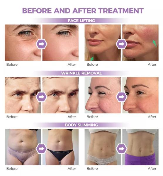 New Design 7d Ultralift 360 Pain less Hifu Face Lifting System Weinkle Removal Smas Body Weight Loss Vmax Skin Lifting Slim Machine Factory Supply