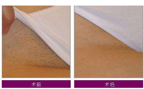 Skin Rejuvenation Multifunctions Ipl Shr Hair Removal Machine For Aesthetic Salon