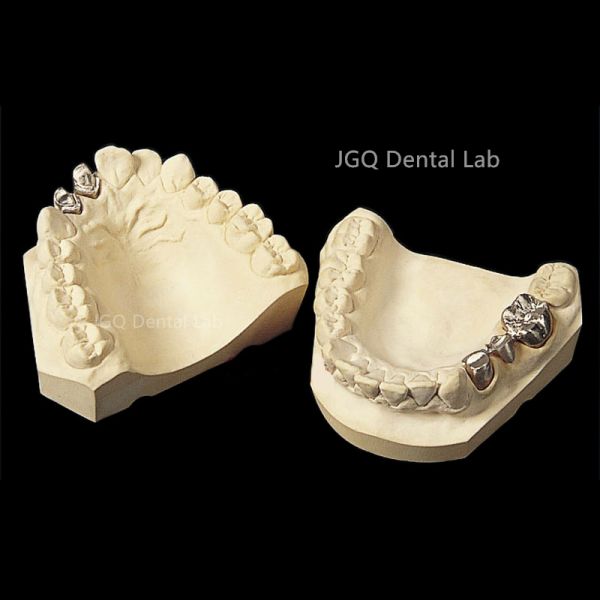 Porcelain Fused to Metal Crown and Bridge Made in China Dental Lab