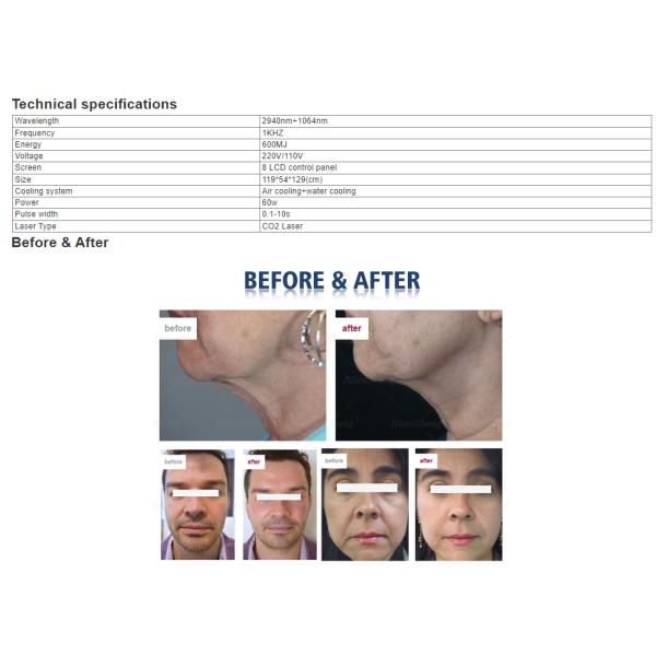 Factory Price Fotona 4D PRO 2940nm Erbium Laser +1064nm ND: YAG Laser Fotona 4D Er YAG Hair Removal