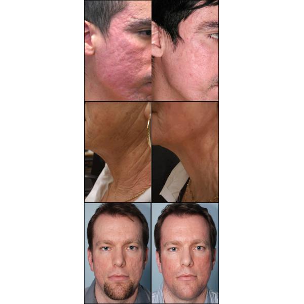 Manufacturer supply 2Mhz portable fractional RF micro needle machine for Wrinkle removal Facial wrinkle removal