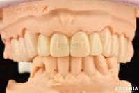 Biocompatible PMMA M75 Restauración Resistente a los arañazos para la estética dental