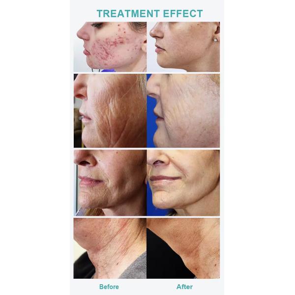 Beauty Facial Spa Wrinkle Removal Skin Tightening Meso Needles Mesotherapy No-needle Mesotherapy Device Mesotherapy Gun