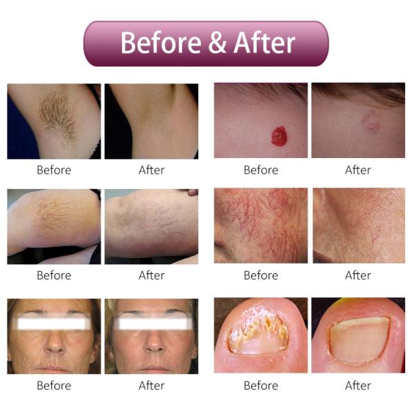 Hair Removal Alexandrite Laser Machine