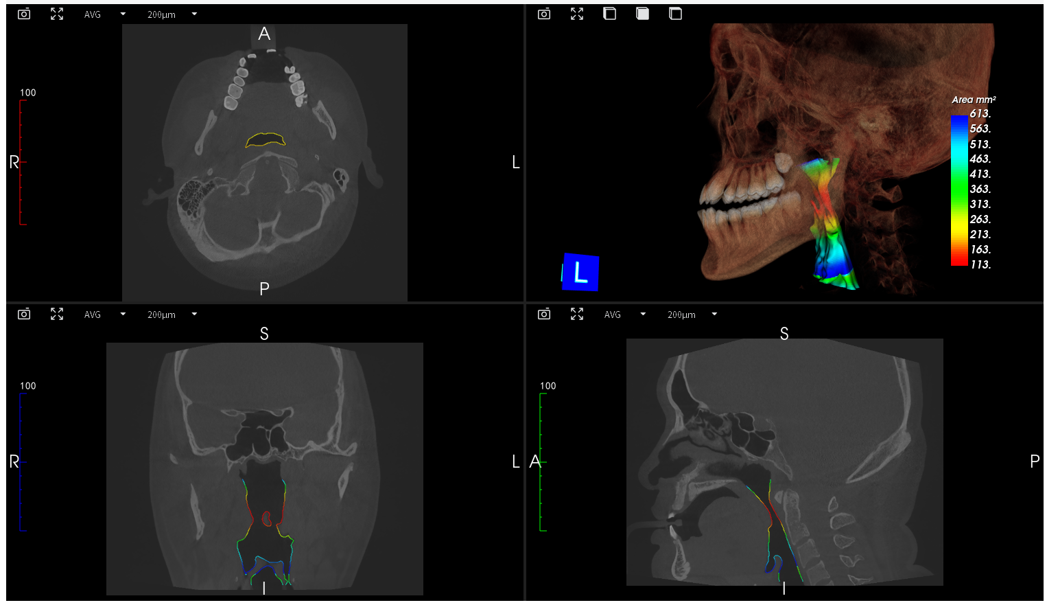 Dental Implant Orthodontic CBCT System High-Resolution 3D Imaging for Precise Diagnosis