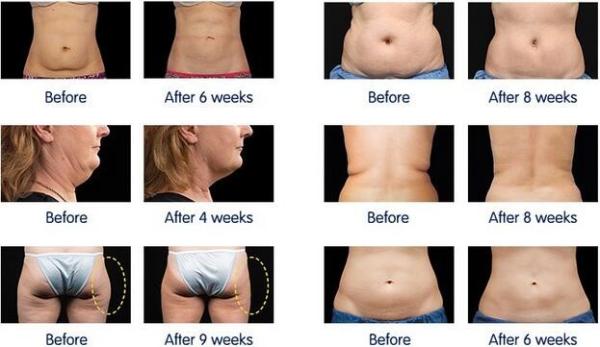 4 Heads Cryolipolysis Freezing Fat Cell Slimming Machine/cool sculpting machines
