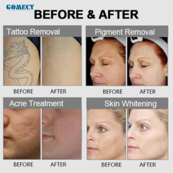 CE Approved Tattoo Removal Machine 1064 532 Nm Picosecond Laser With Air Cooling For Salon Clinic
