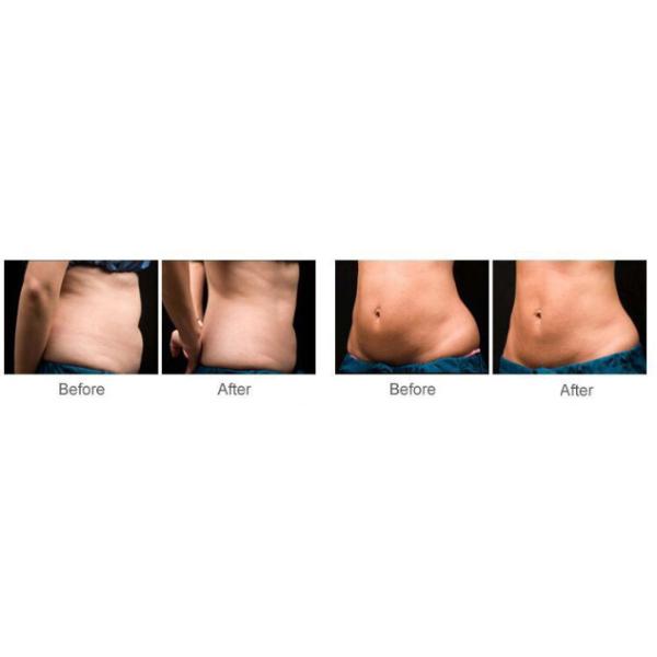 ISO Ultrasound Face Lift Machine HIFU Treatment For Fat Loss Non - Invasively