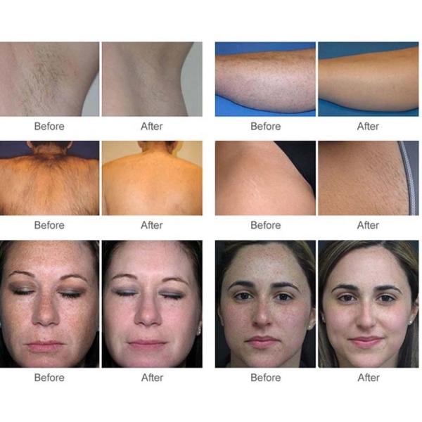 Машина удаления волос депиляции 808nm диода оборудования красоты лазера подмолаживания кожи