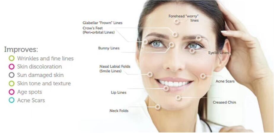 Термальное частичное удаление шрама машины RF Microneedle