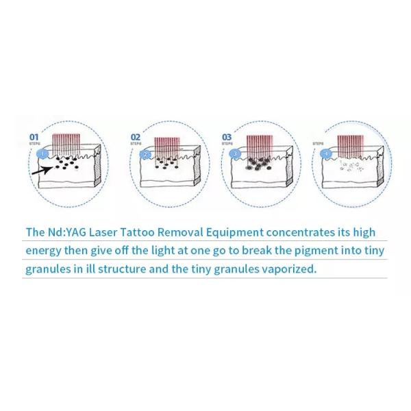 Машина удаления татуировки Nd Yag длины волны 1064nm случая 3 вагонетки