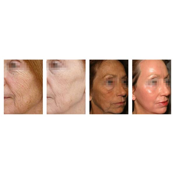 Professional 10600nm Wavelength CO2 Fractional Laser Machine For Surgical cutting Face Renewing