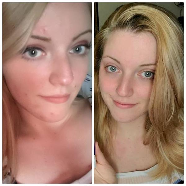 Antimicrobiano Peróxido de benzoilo Acné espumante Limpieza facial sin olor