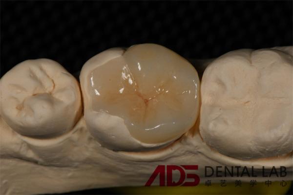 Seamless Porcelain Emax Veneers Teeth Replacement Authentic Looking
