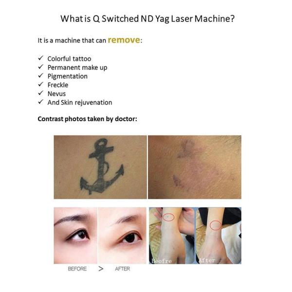 1064nm 532nm 1320nm Nd Yag équipement laser portable pour le blanchiment de la peau