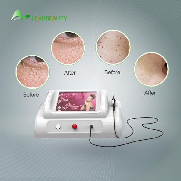 30Mhz high frequency Spider Vein removal price / using for vascular removal with 8.4 inch screen /150W skin tag removal