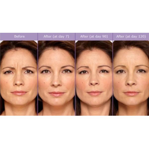 Блоки удаления 100 морщинки Botulinum впрыски токсина анти-