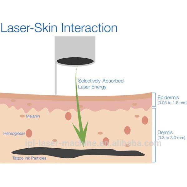 Discount price! Discount price! nd yag laser tattoo and nail fungus removal for tattoo removal, age pigment & freckle re