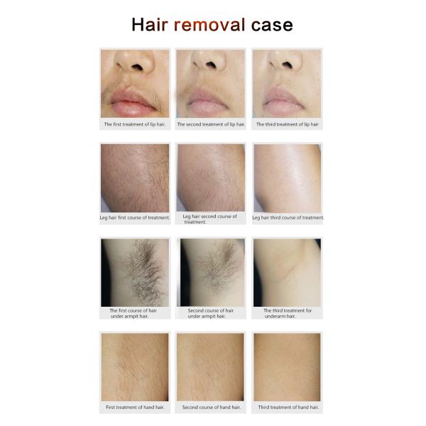 Pain Free 808nm Diode Laser Hair Removal Machine Non Channel Type For All Skins