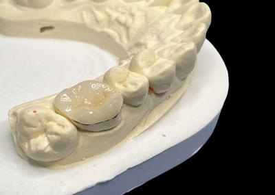 Reparação de dentes hipoalergênicos Inlações de porcelana Onlays de cor natural Manutenção fácil