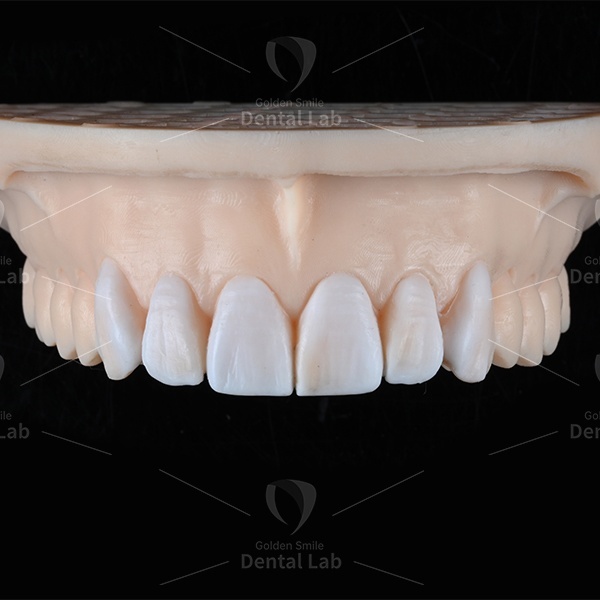 Non Prep Diagnostic Wax Up For Veneers Rehab Full Mouth Wax Up