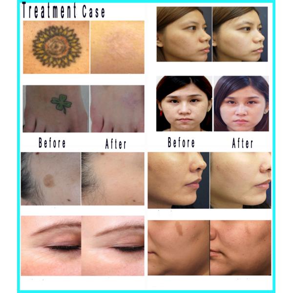 Picosure 532nm / 755nm / 1064nm ND YAG Laser Machine Tatto Removal Machine