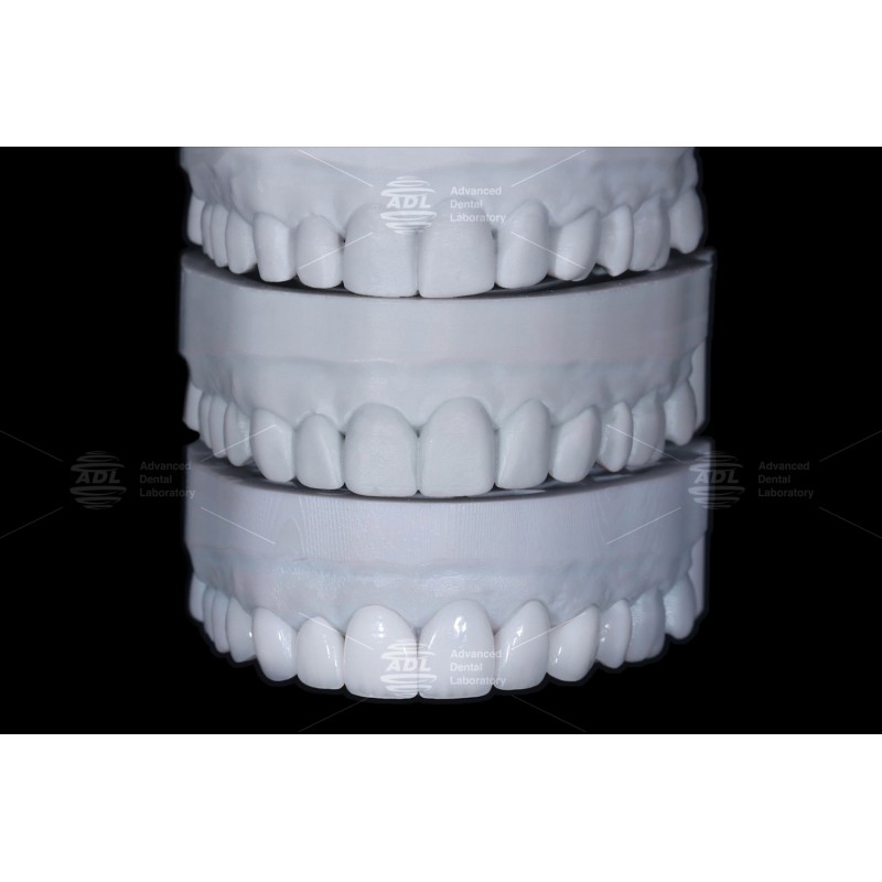 China Dental Lab High Esthetics Translucency EMAX Veneer with 0.3-0.5mm Thickness for Anterior and Posterior Restorations