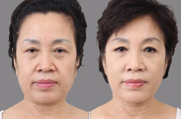 Beauty & Personal Care HIFU FACE hifu focused ultrasound beauty treatment for instant face lifting