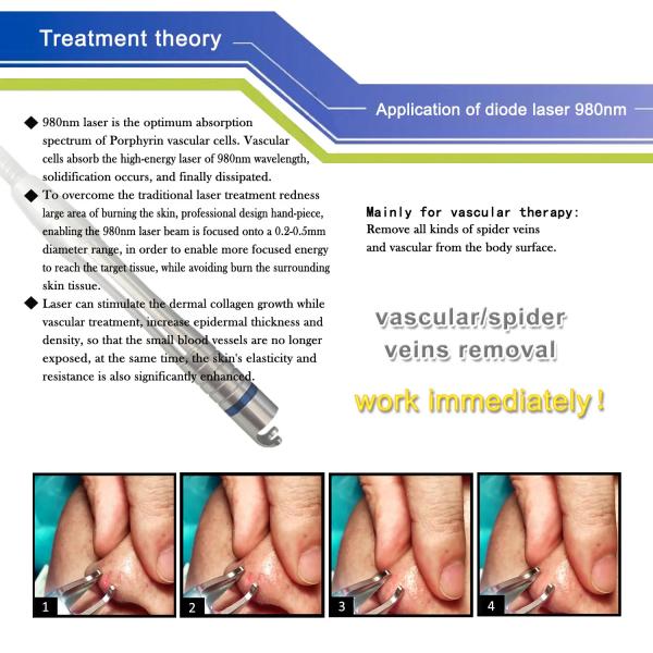Диод ноги 980nm портативной васкулярной машины удаления вены паука лазера 30w лицевой