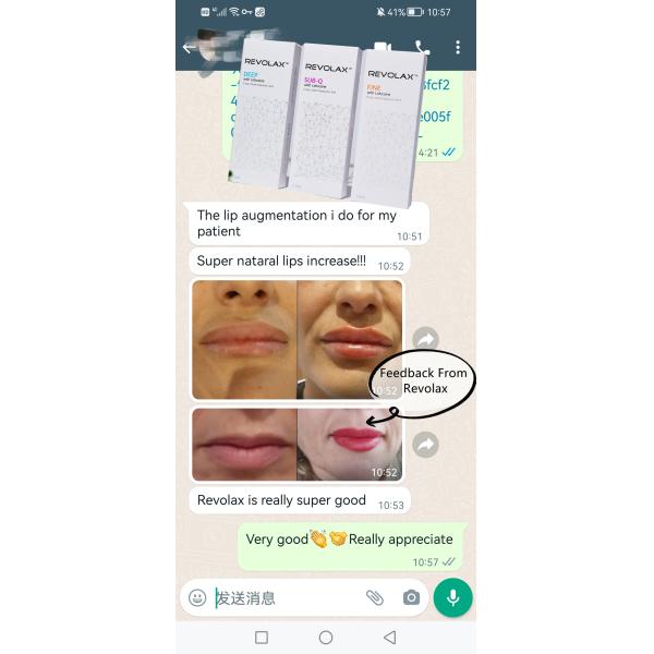 впрыски заполнителя 1.1ml Revolax Hyaluronic кисловочные дермальные для косметических применений