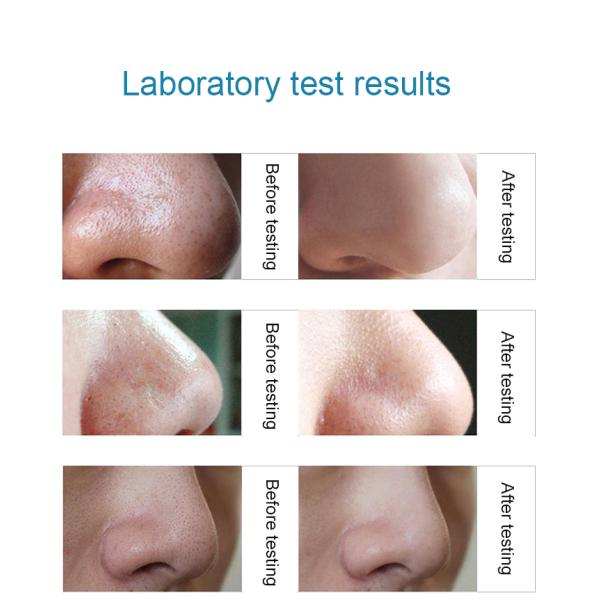 Eco Friendly Electric Blackhead Remover Tool Beauty Skin Acne Rejuvenation