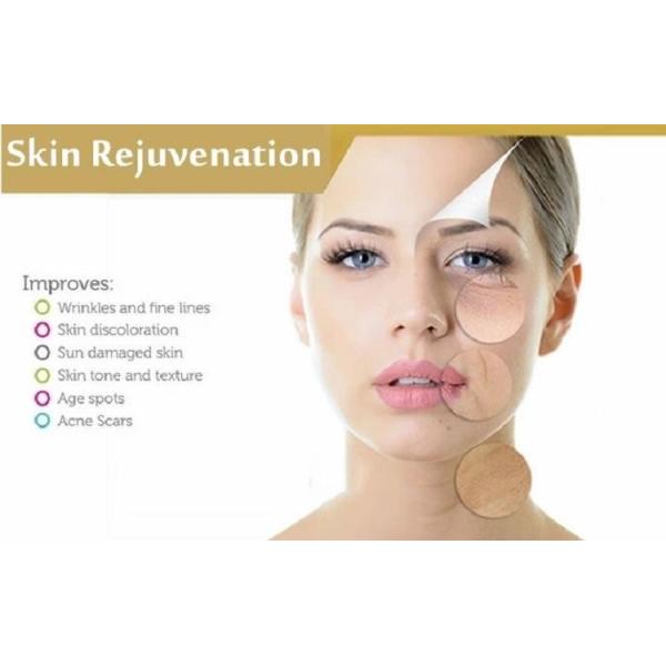 Машина лазера удаления шрама угорь машины RF Microneedling 2 ручек Nano