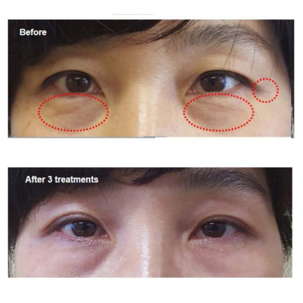 2 Handles Plasma Multifunctional Beauty Machine Wrinkle Stretch Mark Treatment