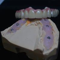La personnalisation convenable parfaite dans des nos couronnes d'implant dentaire