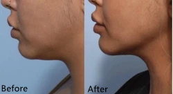 Самая лучшая растворяя впрыска для жидкости двойного Chin