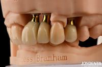 Implants dentaires de précision couronne et pont Solution parfaite pour un sourire esthétique