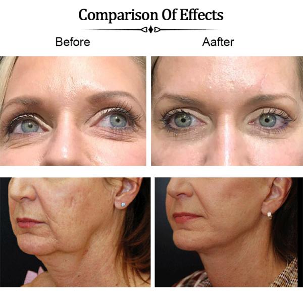 Mono подъем потока Кореи PDO для медицинской кожи затягивая потоки губ