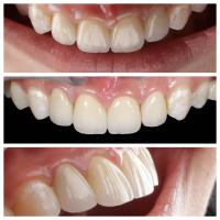Indication des dents antérieures Faisceaux dentaires d'épaisseur de 0,5 mm et parfaite perméabilité