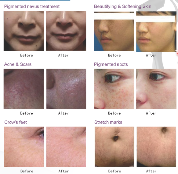 Beijing Sincoheren FDA K and Medical CE approved Fraxel frational Co2 laser with vaginal tips co2 laser facial