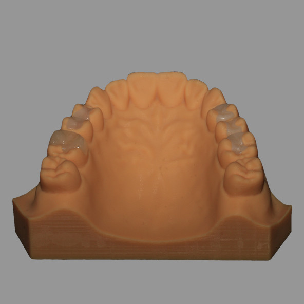 Full Ceramic Dental Emax Inlay Onlay Crown Pressed / Milled