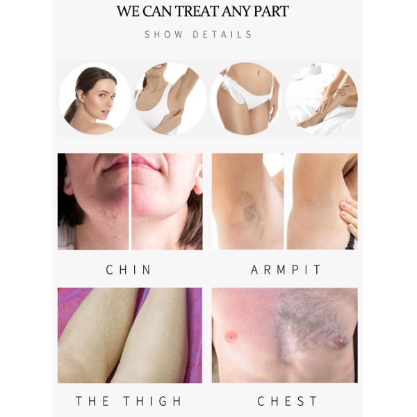 Powerful Triple Wavelength Diode Laser Hair Removal Machine Fast Painless and Effective