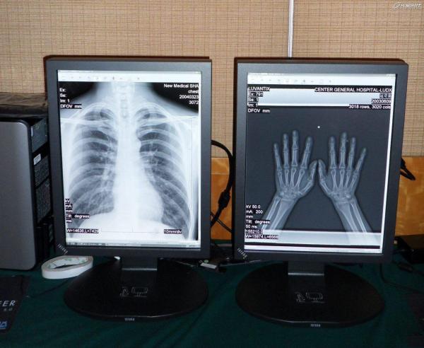 exposição médica da cor 2MP de alta qualidade médica